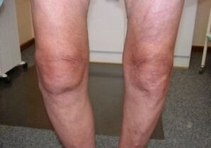 How to treat the arthrosis of the knee joint