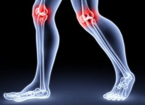 Reasons for the development of knee arthrosis