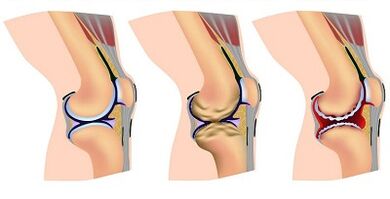 Arthrosis of the knee joint