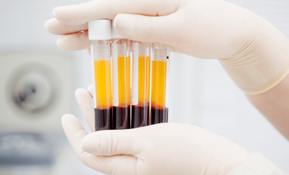 Platelet-rich plasma for PRP treatment for arthrosis